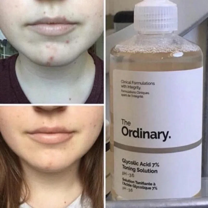 The Ordinary Glycolic Acid 7% Toning Solution
