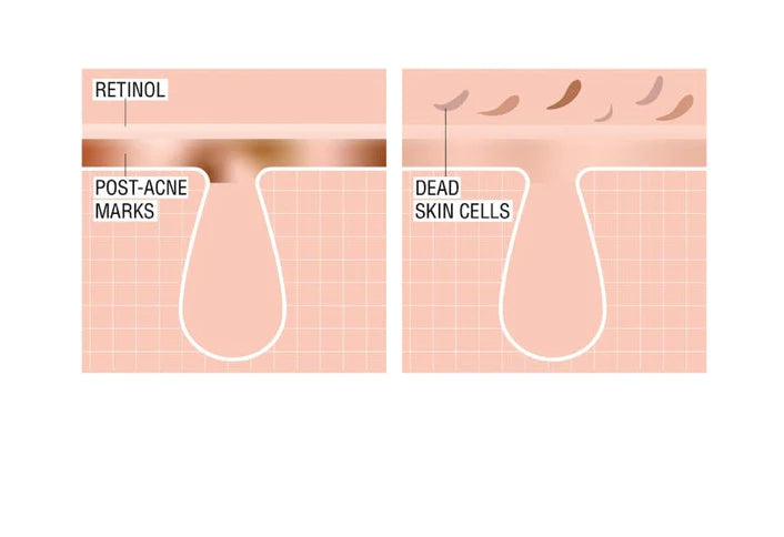 Stubborn Marks PM Tratamiento Neutrogena